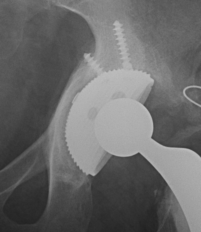 THR Uncemented Cup Acetabular Fracture